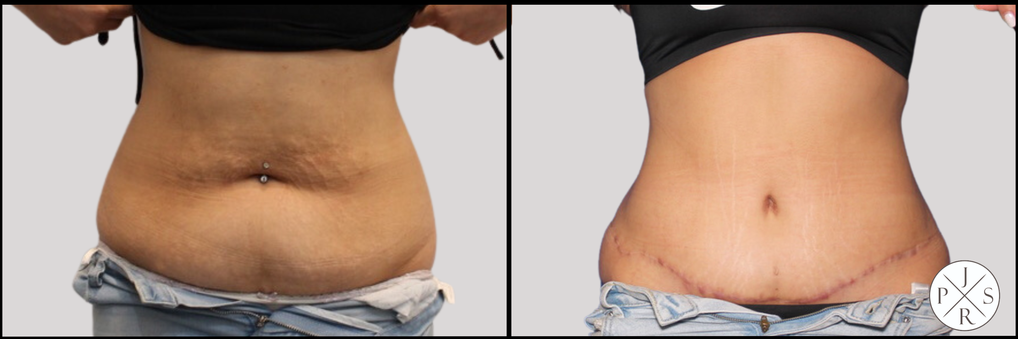 Abdominoplasty Before & After Image